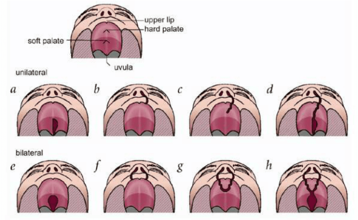 Cleft lip and palate diagram