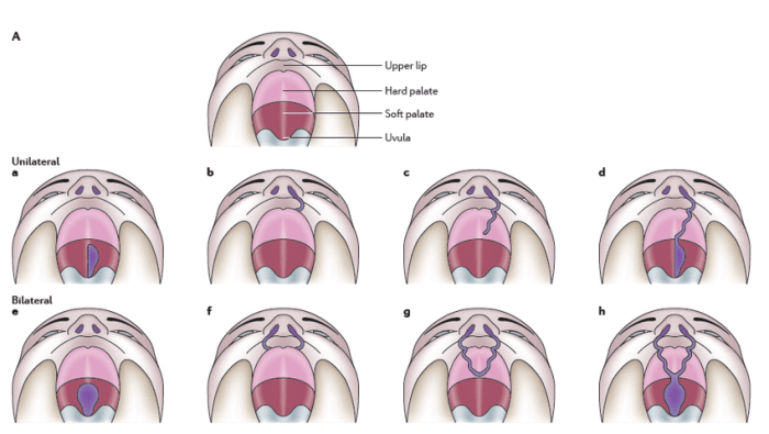 Cleft palate lip diagram types clefts quality life orofacial corp hindawi publishing graphic