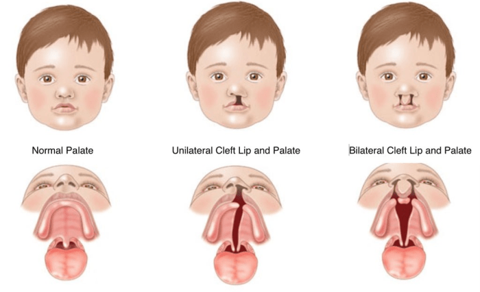 Cleft lip and palate diagram