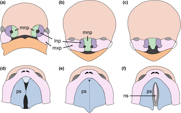 Cleft palate lip syndrome digeorge surgery lips kidshealth bilateral quotes speech treatment categories after quotesgram types pediatric development left mouth