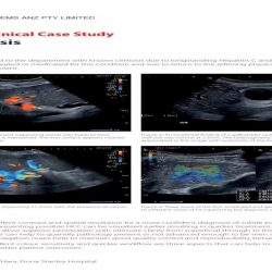 Case study about liver cirrhosis